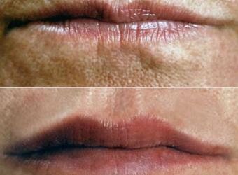 Facts About Juvederm and Lips