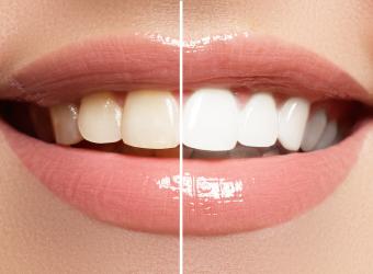 The 3 Best Cosmetic Dental Procedures for a White Smile