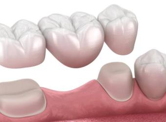 Dental Bridge Materials: Exploring Options for Aesthetic and Functional Results