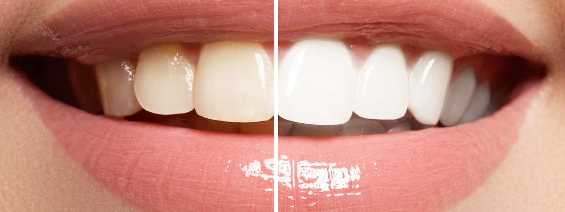 Cosmetic Dental Procedures Cosmetic Dental Procedures